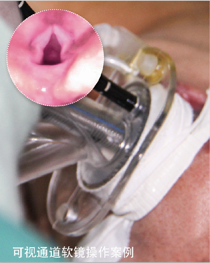 麻醉手術(shù)中氣道管理多功能喉罩可視通道軟鏡操作案例